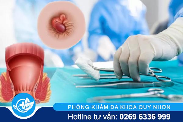 Mổ trĩ có đau không? Sự thật nhiều người bất ngờ