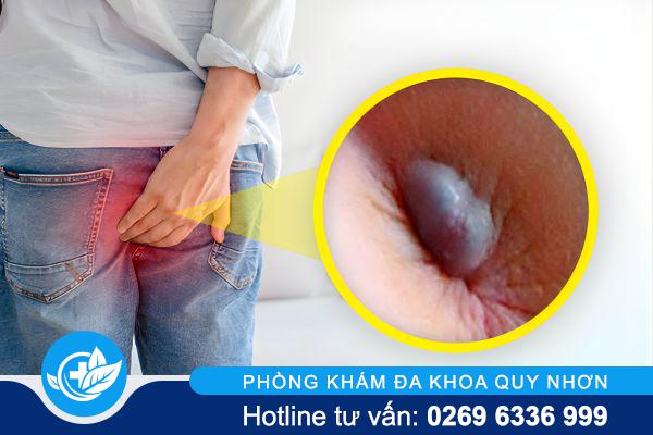 Cục thịt dư hậu môn: Nhỏ nhưng tiềm ẩn rủi ro lớn