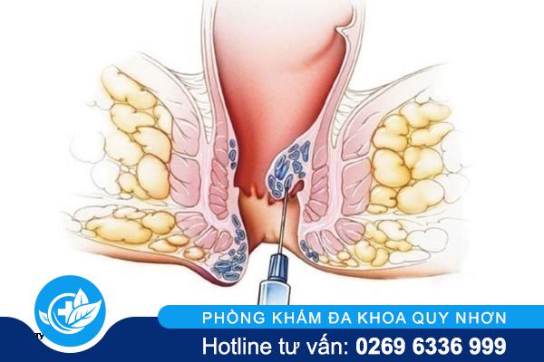 5 điều cần biết trước khi tiêm xơ búi trĩ